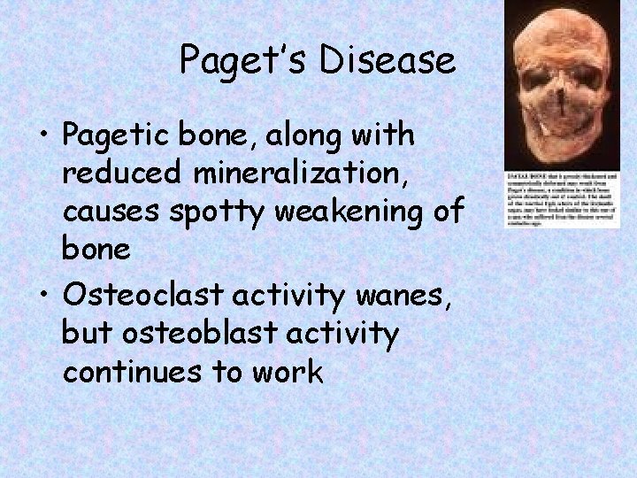 Paget’s Disease • Pagetic bone, along with reduced mineralization, causes spotty weakening of bone