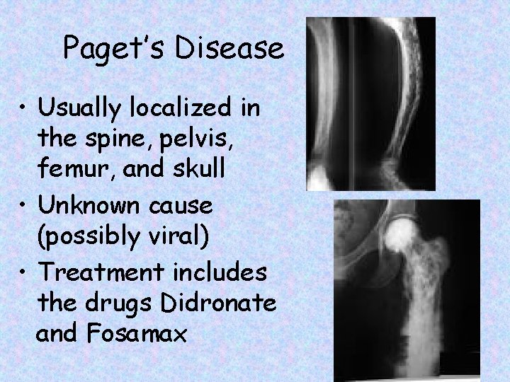Paget’s Disease • Usually localized in the spine, pelvis, femur, and skull • Unknown