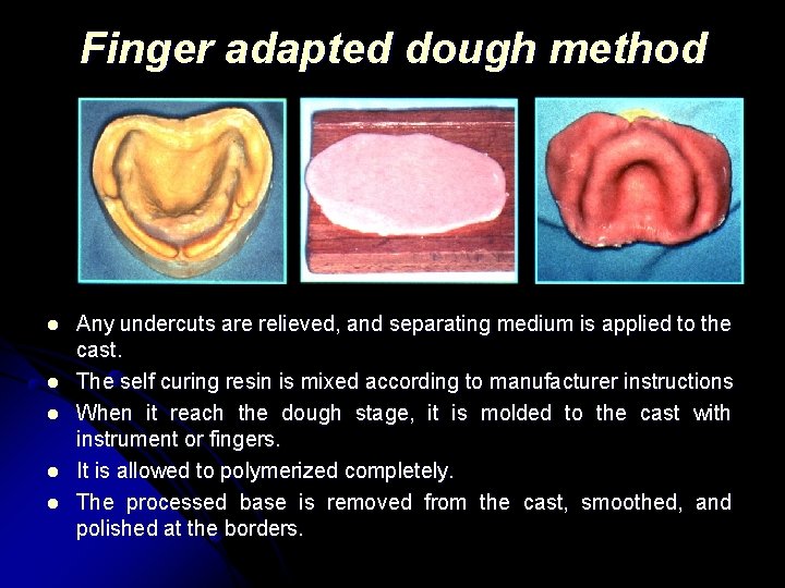 Finger adapted dough method l l l Any undercuts are relieved, and separating medium
