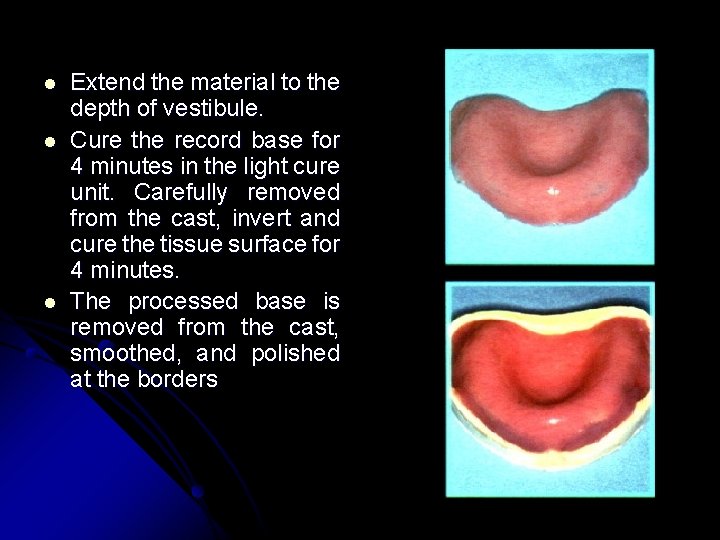 l l l Extend the material to the depth of vestibule. Cure the record