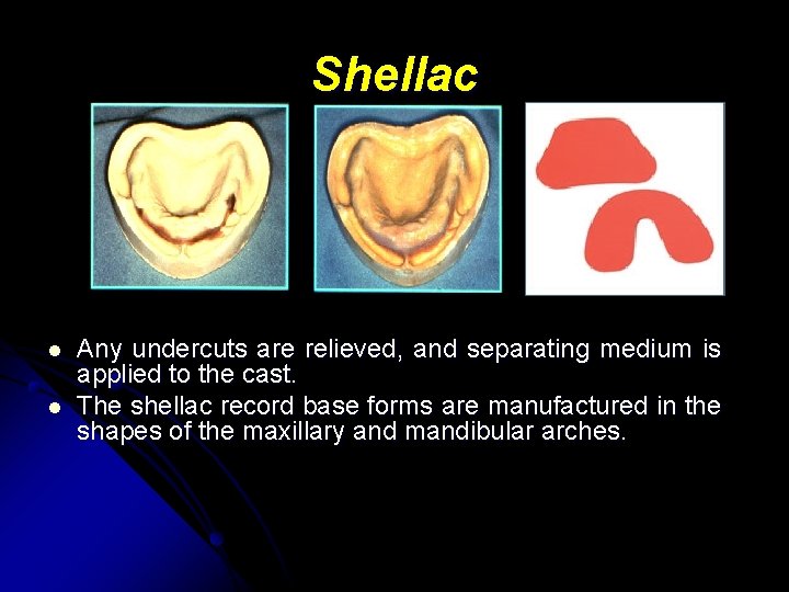Shellac l l Any undercuts are relieved, and separating medium is applied to the