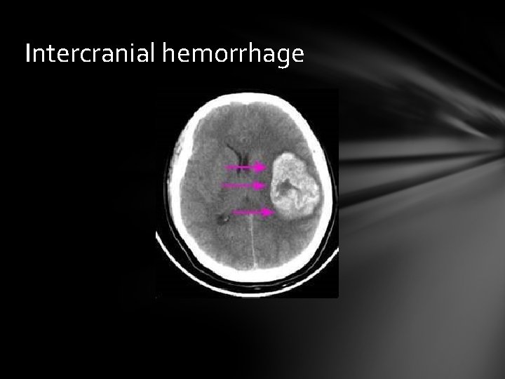 Intercranial hemorrhage 