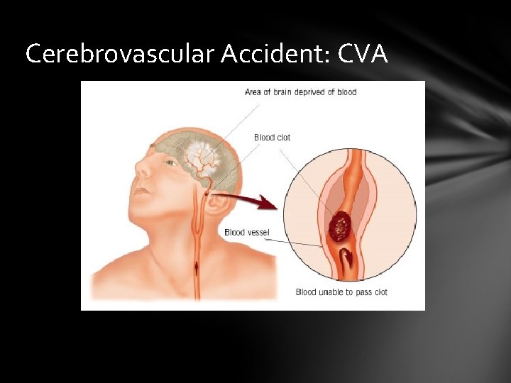 Cerebrovascular Accident: CVA 