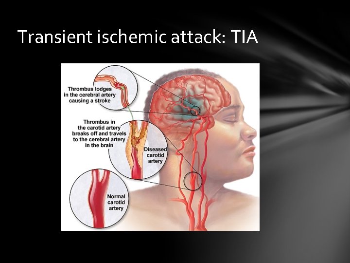 Transient ischemic attack: TIA 