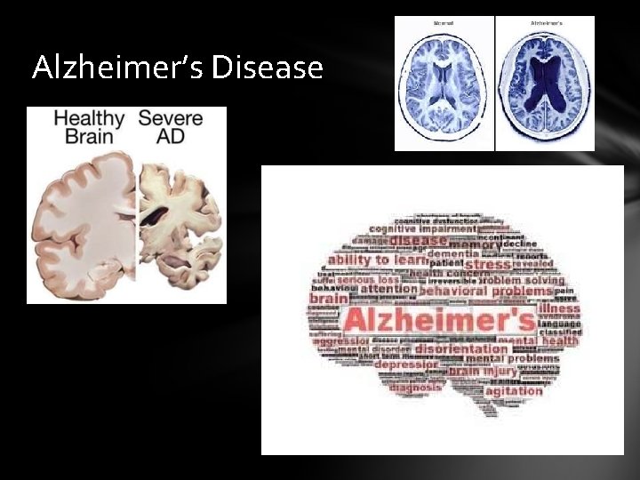 Alzheimer’s Disease 