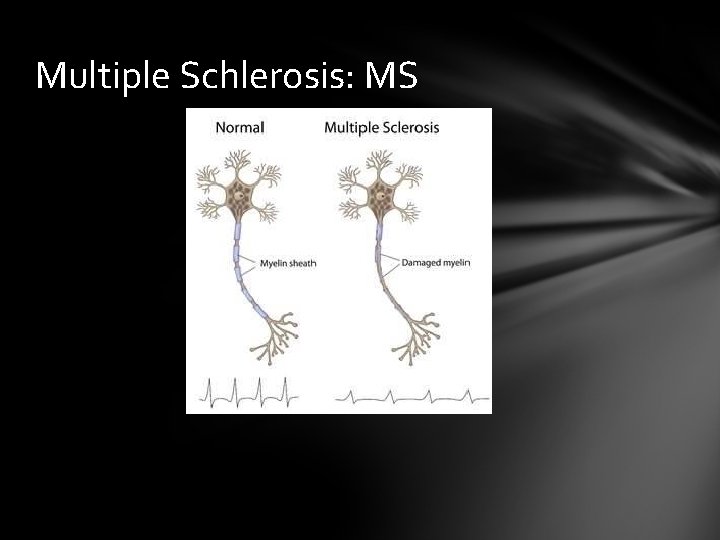 Multiple Schlerosis: MS 