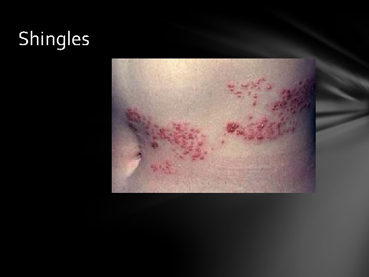 Shingles 