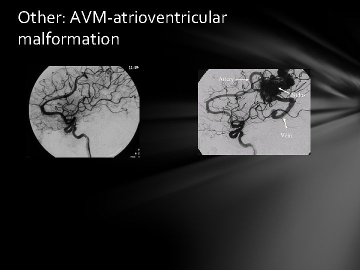 Other: AVM-atrioventricular malformation 