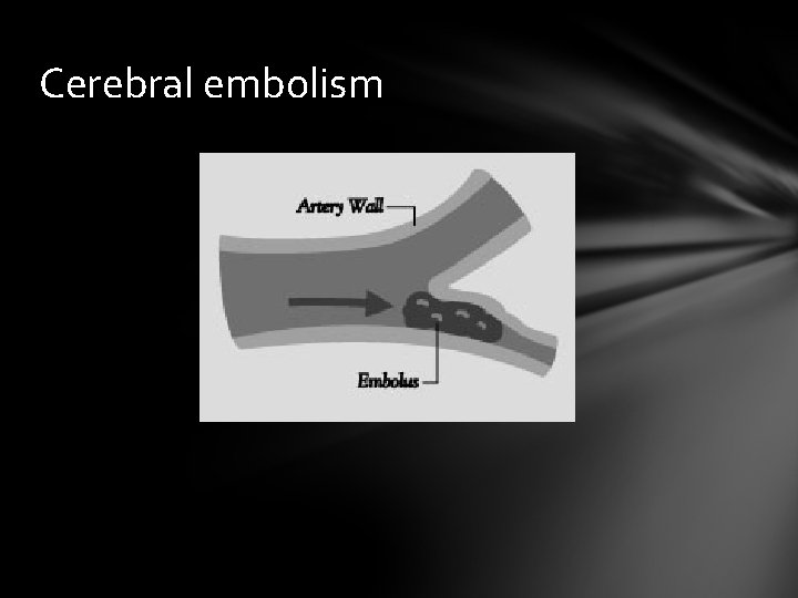 Cerebral embolism 