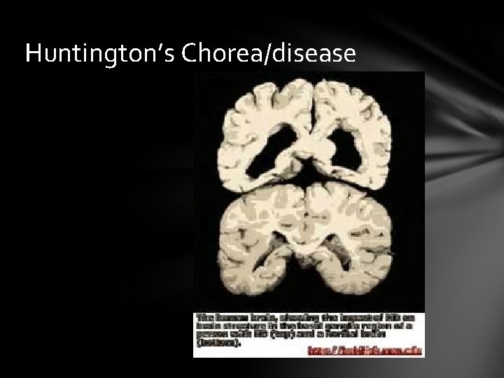 Huntington’s Chorea/disease 