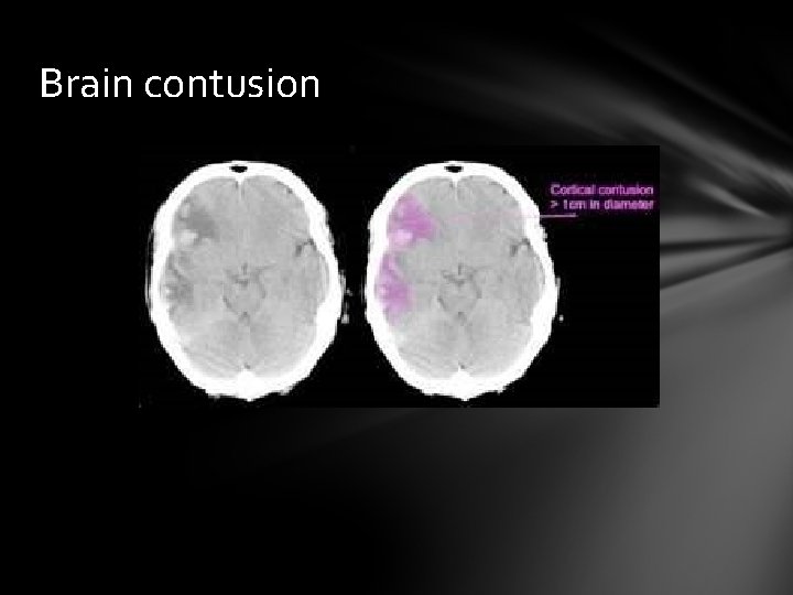 Brain contusion 
