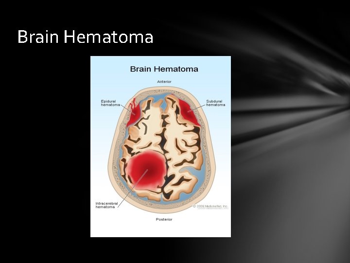 Brain Hematoma 