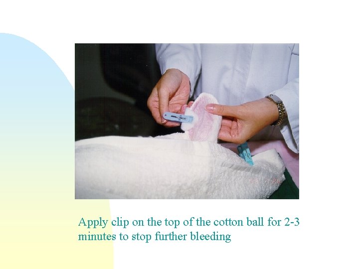 Apply clip on the top of the cotton ball for 2 -3 minutes to