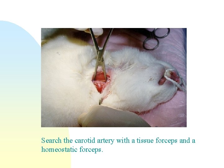 Search the carotid artery with a tissue forceps and a homeostatic forceps. 