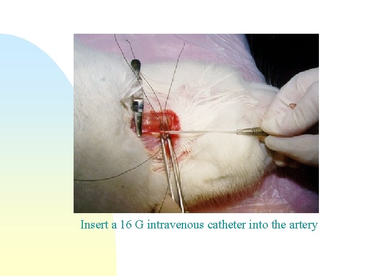 Insert a 16 G intravenous catheter into the artery 