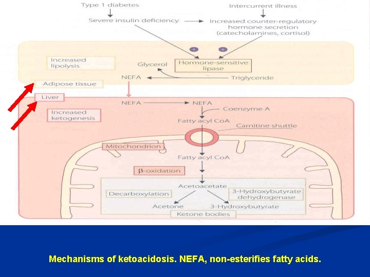 Mechanisms of ketoacidosis. NEFA, non-esterifies fatty acids. 