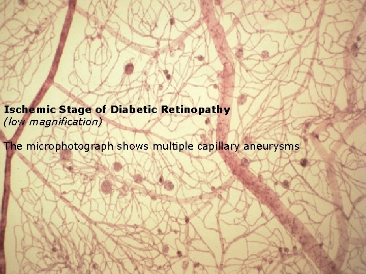 Ischemic Stage of Diabetic Retinopathy (low magnification) The microphotograph shows multiple capillary aneurysms 