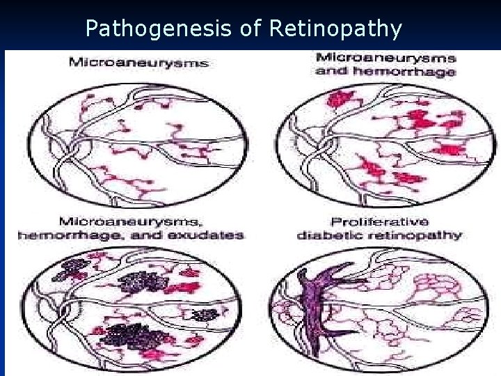 Pathogenesis of Retinopathy 