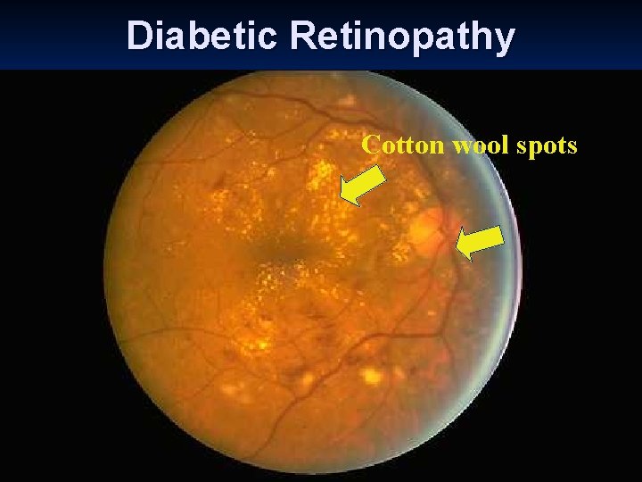 Diabetic Retinopathy Cotton wool spots 