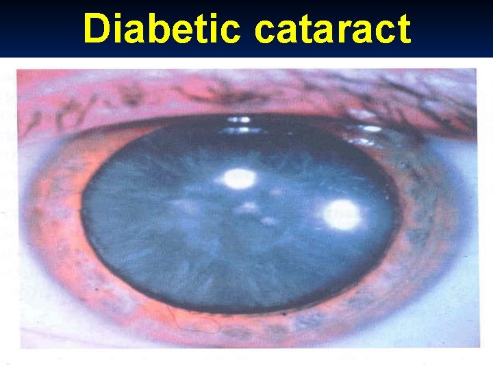 Diabetic cataract 