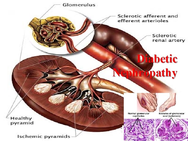 Diabetic Nephropathy 