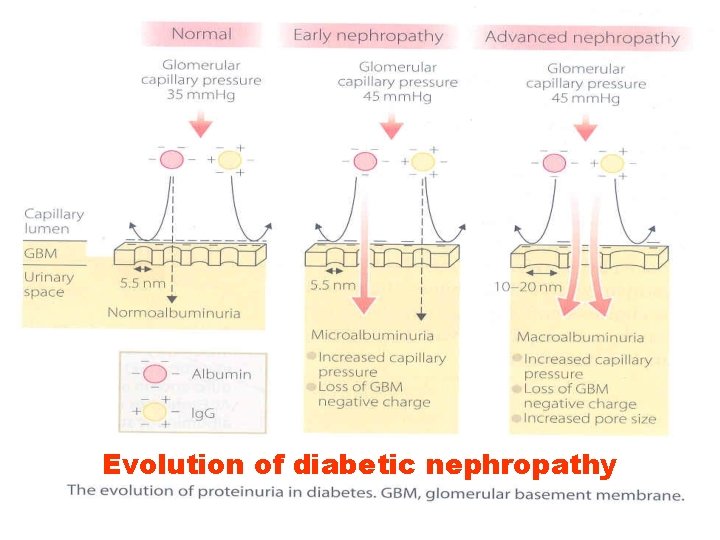 Evolution of diabetic nephropathy 