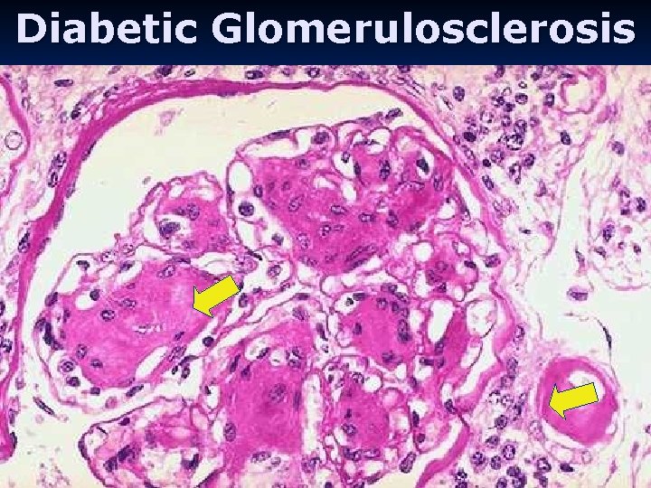 Diabetic Glomerulosclerosis 
