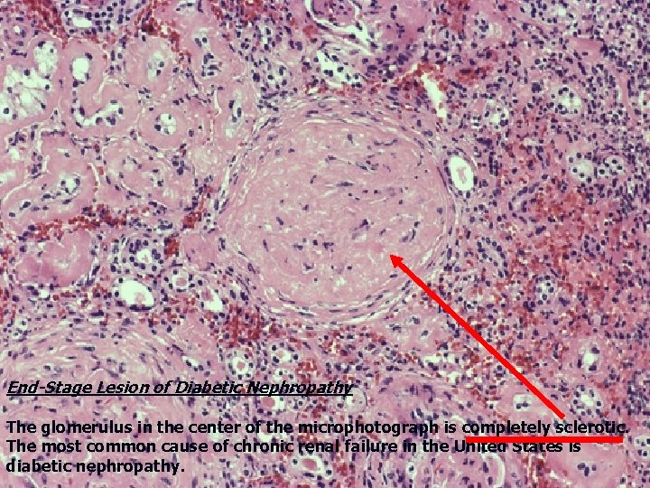 End-Stage Lesion of Diabetic Nephropathy The glomerulus in the center of the microphotograph is