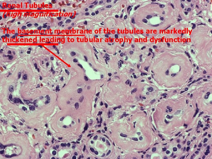 Renal Tubules (high magnification) The basement membrane of the tubules are markedly thickened leading