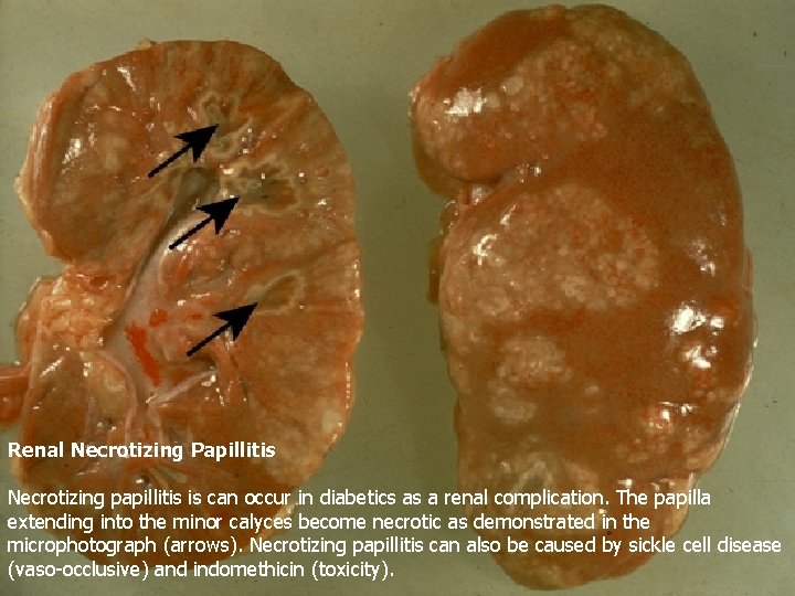 Renal Necrotizing Papillitis Necrotizing papillitis is can occur in diabetics as a renal complication.