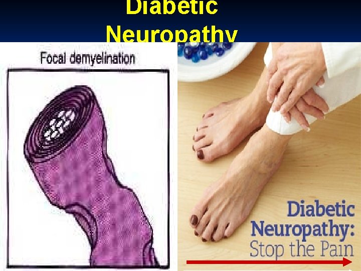 Diabetic Neuropathy 