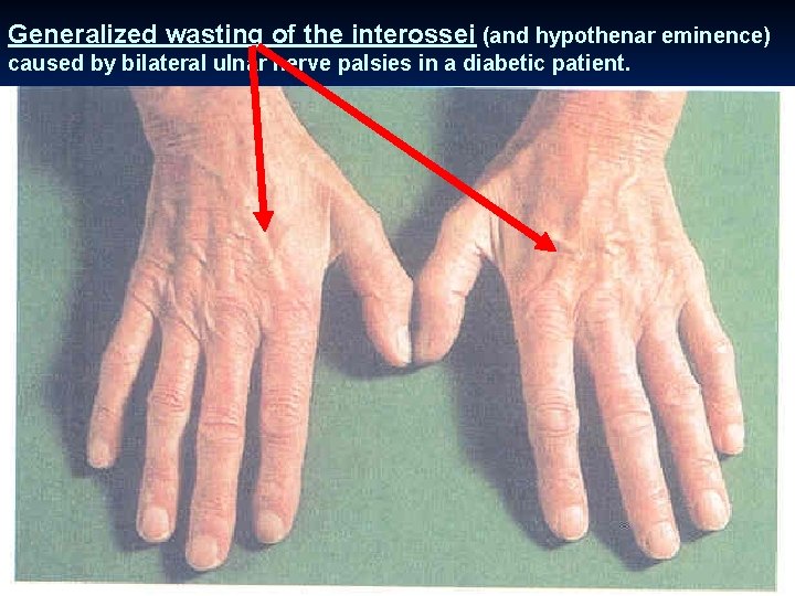 Generalized wasting of the interossei (and hypothenar eminence) caused by bilateral ulnar nerve palsies