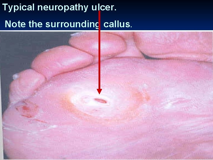 Typical neuropathy ulcer. Note the surrounding callus. 