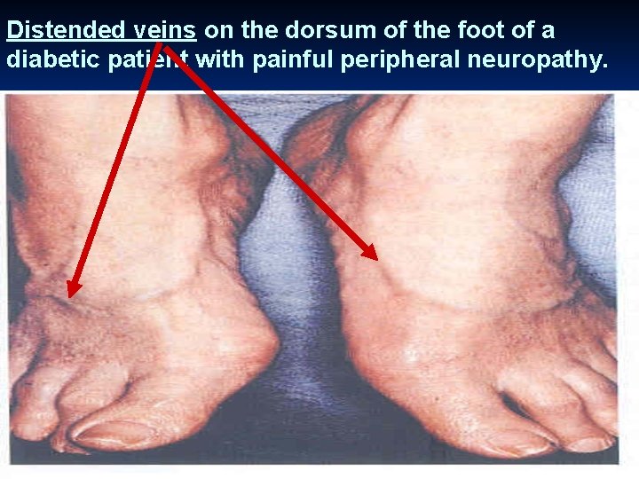 Distended veins on the dorsum of the foot of a diabetic patient with painful
