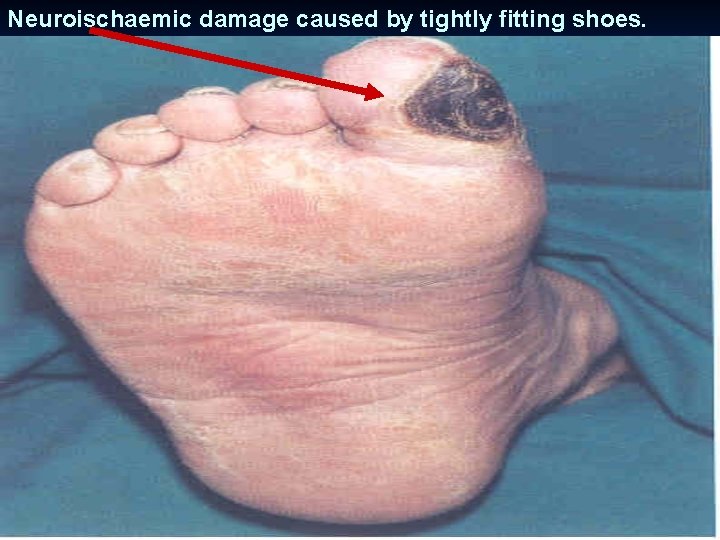 Neuroischaemic damage caused by tightly fitting shoes. 