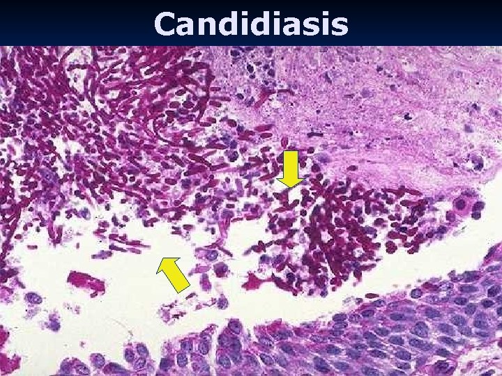 Candidiasis 