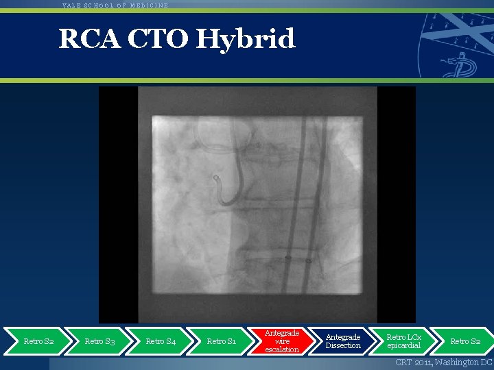 YALE SCHOOL OF MEDICINE RCA CTO Hybrid Retro S 2 Retro S 3 Retro
