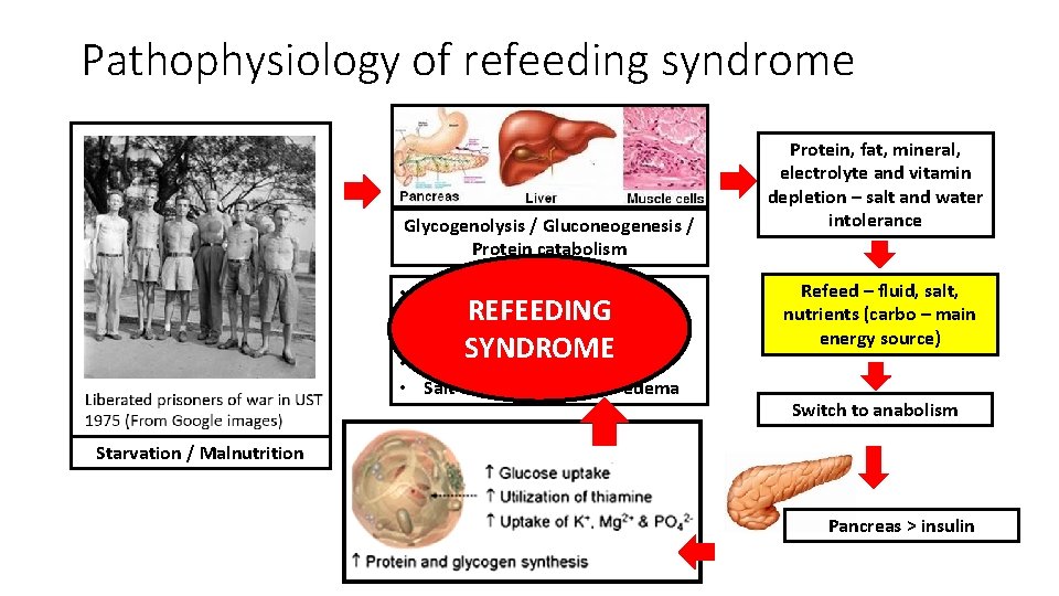 Pathophysiology of refeeding syndrome Glycogenolysis / Gluconeogenesis / Protein catabolism • • • Hypophosphatemia Pathophysiology of refeeding syndrome Glycogenolysis / Gluconeogenesis / Protein catabolism • • • Hypophosphatemia