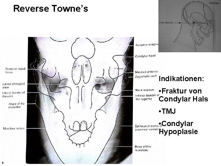 Reverse Towne’s Indikationen: • Fraktur von Condylar Hals • TMJ • Condylar Hypoplasie 