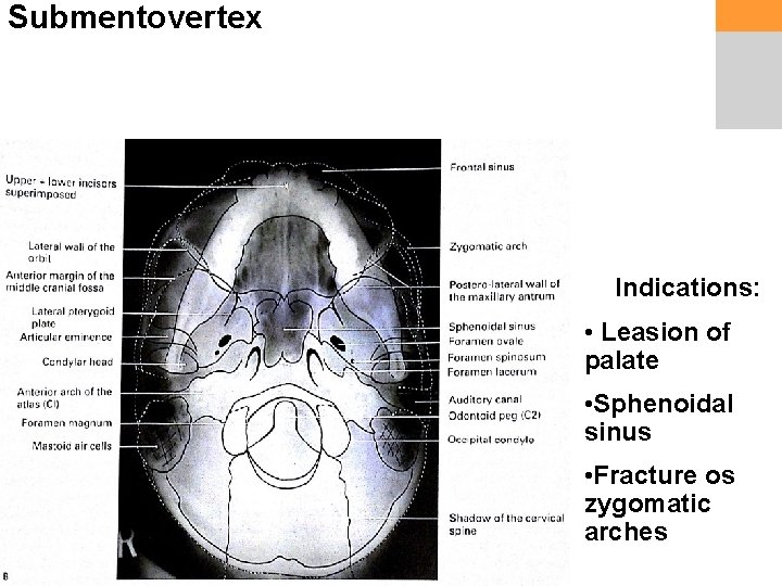 Submentovertex Indications: • Leasion of palate • Sphenoidal sinus • Fracture os zygomatic arches