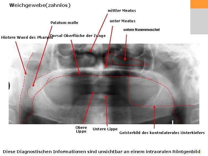 Weichgewebe(zahnlos) mittler Meatus unter Meatus Palatum molle untere Nasenmuschel Dorsal Oberfläche der Zunge Hintere