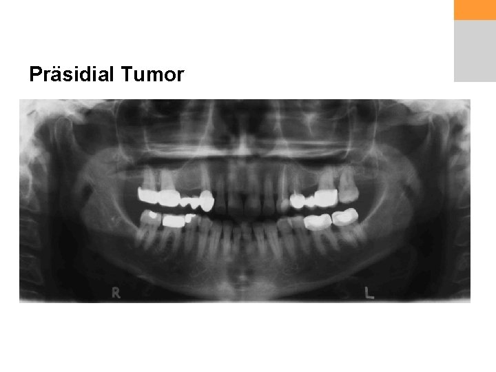 Präsidial Tumor 