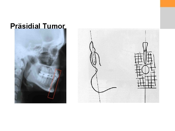 Präsidial Tumor 