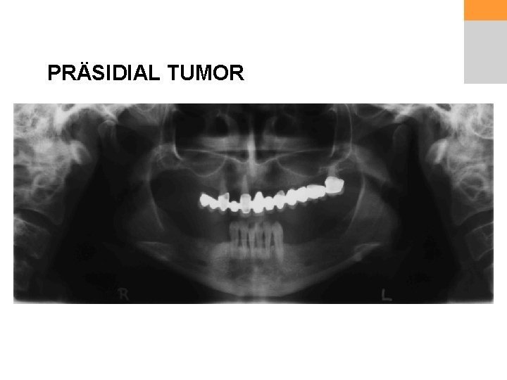 PRÄSIDIAL TUMOR 