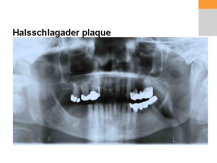 Halsschlagader plaque 