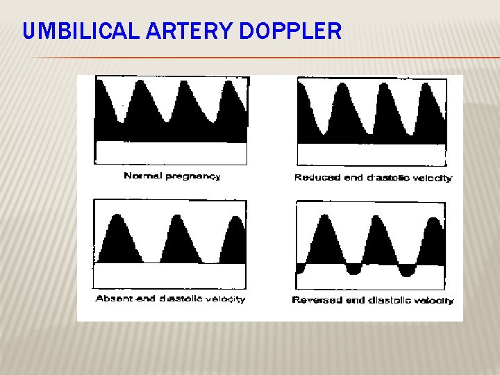 UMBILICAL ARTERY DOPPLER 