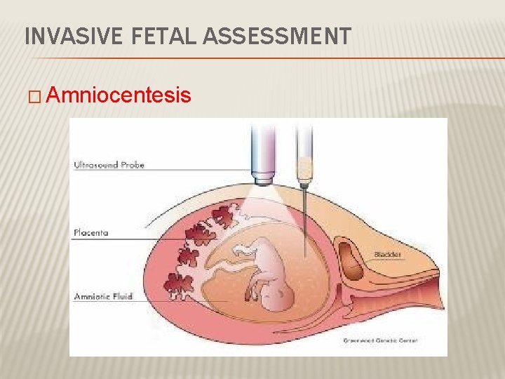 INVASIVE FETAL ASSESSMENT � Amniocentesis 