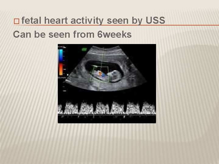 � fetal heart activity seen by USS Can be seen from 6 weeks 