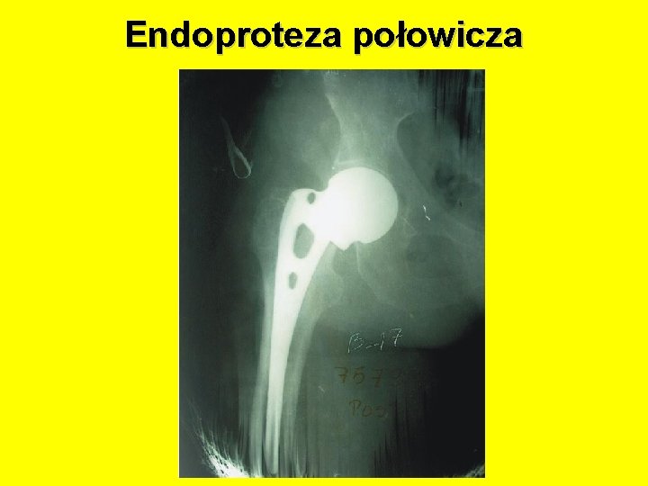 Endoproteza połowicza 