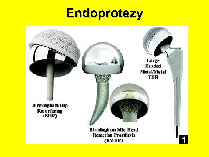 Endoprotezy 